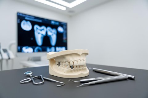 All-on-4 ou prothèse amovible : comparaison de la stabilité, du confort, de l’entretien et du coût